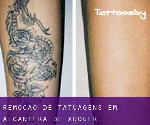 Remoção de tatuagens em Alcàntera de Xúquer