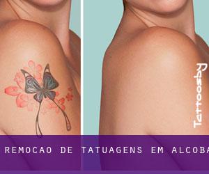 Remoção de tatuagens em Alcoba