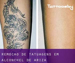 Remoção de tatuagens em Alconchel de Ariza