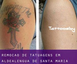 Remoção de tatuagens em Aldealengua de Santa María