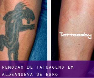 Remoção de tatuagens em Aldeanueva de Ebro
