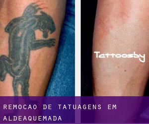 Remoção de tatuagens em Aldeaquemada