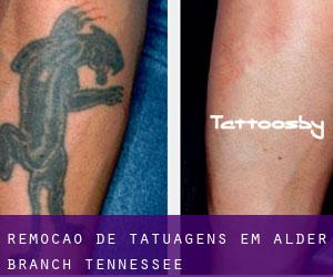 Remoção de tatuagens em Alder Branch (Tennessee)