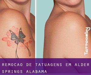 Remoção de tatuagens em Alder Springs (Alabama)