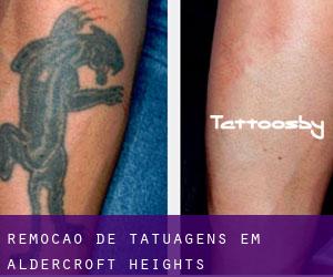 Remoção de tatuagens em Aldercroft Heights