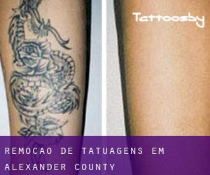 Remoção de tatuagens em Alexander County