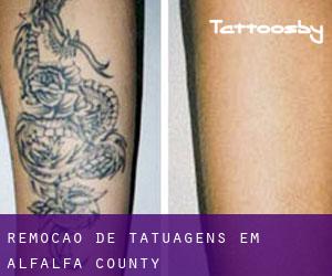 Remoção de tatuagens em Alfalfa County