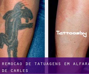 Remoção de tatuagens em Alfara de Carles