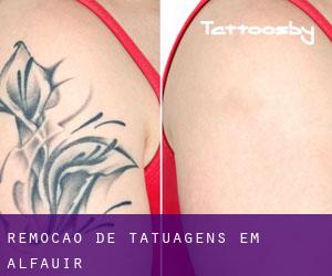 Remoção de tatuagens em Alfauir