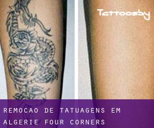 Remoção de tatuagens em Algerie Four Corners