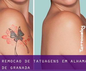 Remoção de tatuagens em Alhama de Granada