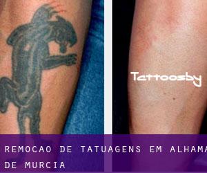 Remoção de tatuagens em Alhama de Murcia