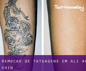Remoção de tatuagens em Ali Ak Chin