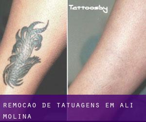 Remoção de tatuagens em Ali Molina
