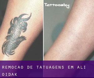Remoção de tatuagens em Ali Oidak