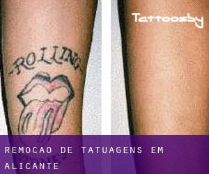 Remoção de tatuagens em Alicante