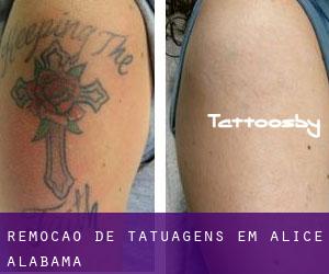 Remoção de tatuagens em Alice (Alabama)