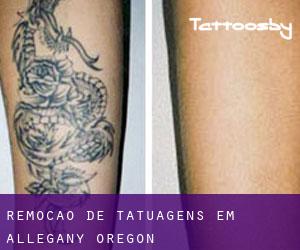 Remoção de tatuagens em Allegany (Oregon)
