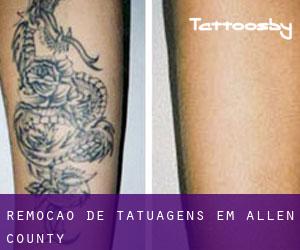 Remoção de tatuagens em Allen County