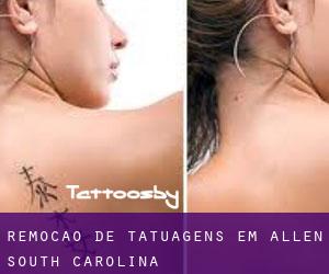 Remoção de tatuagens em Allen (South Carolina)