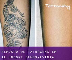 Remoção de tatuagens em Allenport (Pennsylvania)