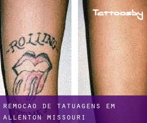Remoção de tatuagens em Allenton (Missouri)
