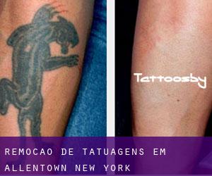 Remoção de tatuagens em Allentown (New York)