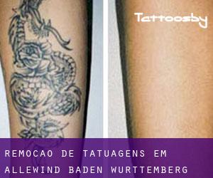 Remoção de tatuagens em Allewind (Baden-Württemberg)