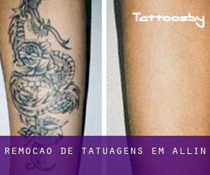 Remoção de tatuagens em Allín
