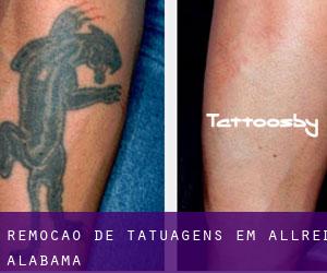 Remoção de tatuagens em Allred (Alabama)