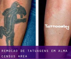 Remoção de tatuagens em Alma (census area)