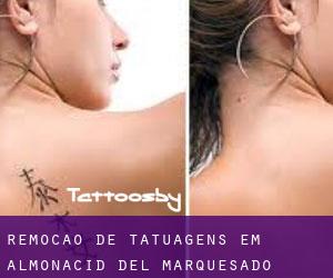 Remoção de tatuagens em Almonacid del Marquesado