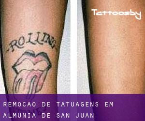 Remoção de tatuagens em Almunia de San Juan