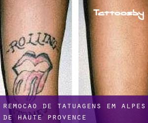 Remoção de tatuagens em Alpes-de-Haute-Provence