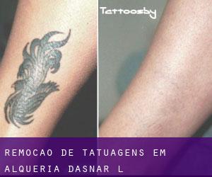 Remoção de tatuagens em Alqueria d'Asnar (l')