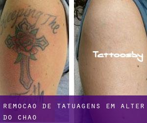 Remoção de tatuagens em Alter do Chão