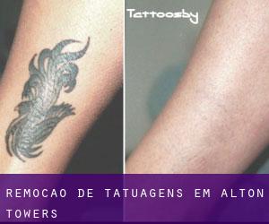Remoção de tatuagens em Alton Towers