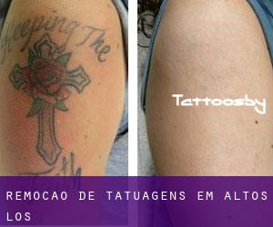Remoção de tatuagens em Altos (Los)