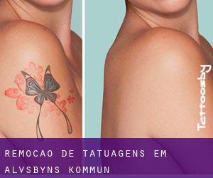 Remoção de tatuagens em Älvsbyns Kommun
