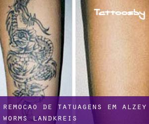 Remoção de tatuagens em Alzey-Worms Landkreis