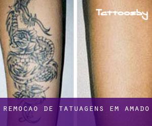 Remoção de tatuagens em Amado