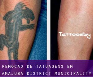 Remoção de tatuagens em Amajuba District Municipality