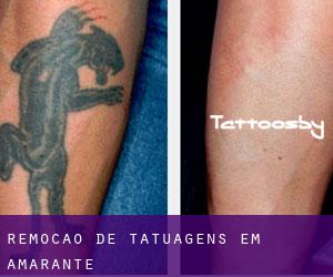 Remoção de tatuagens em Amarante