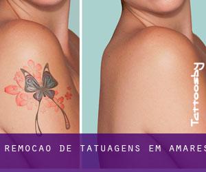 Remoção de tatuagens em Amares
