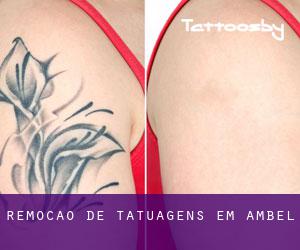 Remoção de tatuagens em Ambel