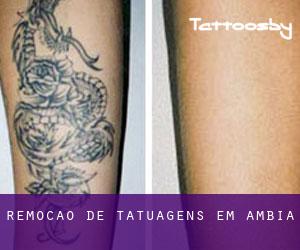 Remoção de tatuagens em Ambía