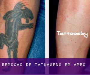 Remoção de tatuagens em Ambo