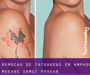 Remoção de tatuagens em Amphoe Mueang Samut Prakan