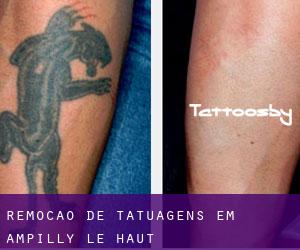 Remoção de tatuagens em Ampilly-le-Haut