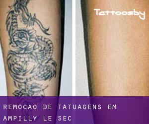 Remoção de tatuagens em Ampilly-le-Sec